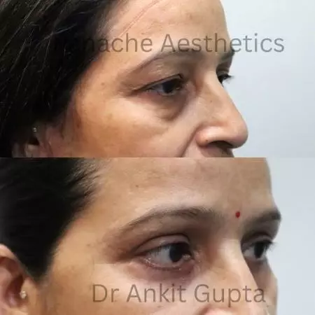 Upper eyelid blepharoplasty before and after — side profile of hooded lid lift by Dr. Ankit Gupta, Panache Aesthetics Delhi